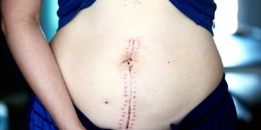 Unlu-Sarkicidan-13-Burun-Ameliyati-Sonrasi-Buyuk-Duyuru-featured